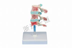 生物及医疗模型SM-M008骨质疏松模型